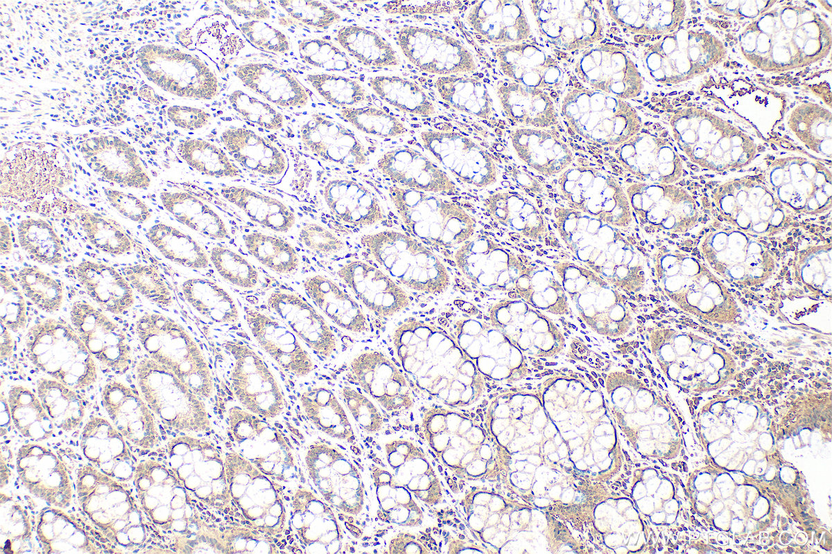 Immunohistochemistry (IHC) staining of human rectal cancer tissue using AEG-1/MTDH Monoclonal antibody (68592-1-Ig)