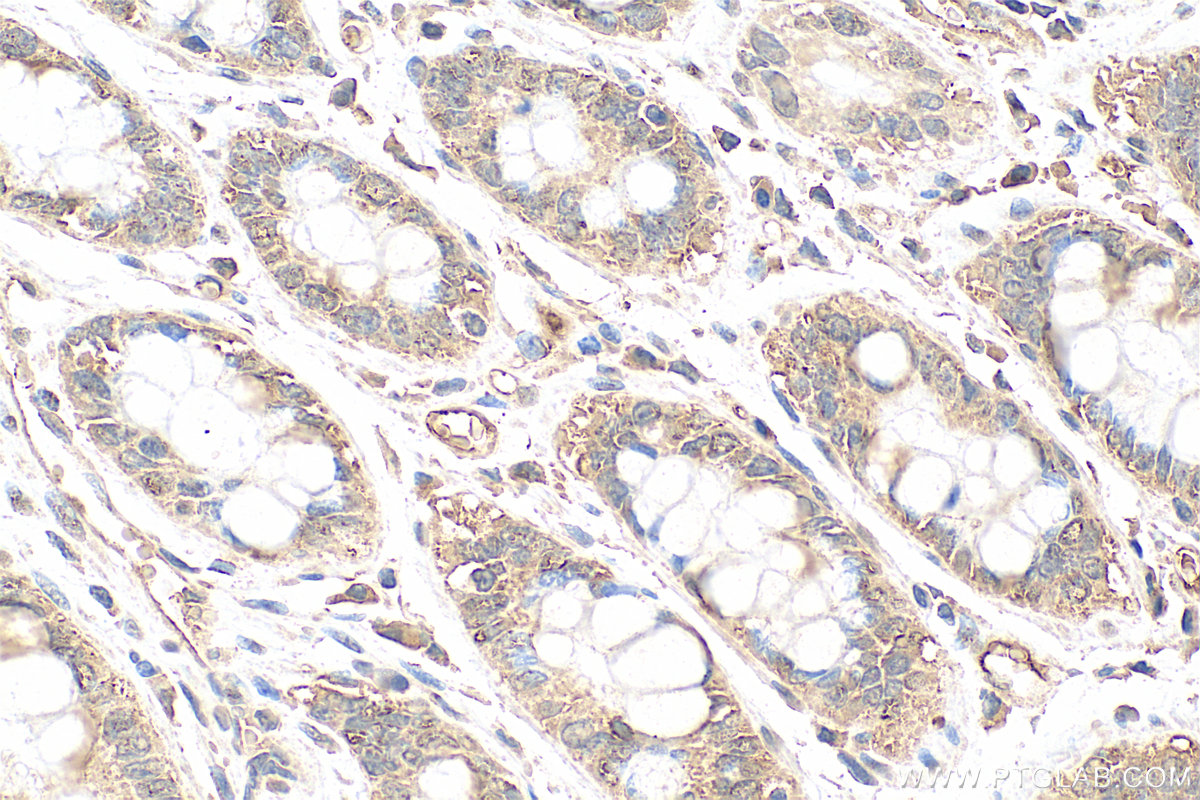 Immunohistochemistry (IHC) staining of human rectal cancer tissue using AEG-1/MTDH Monoclonal antibody (68592-1-Ig)