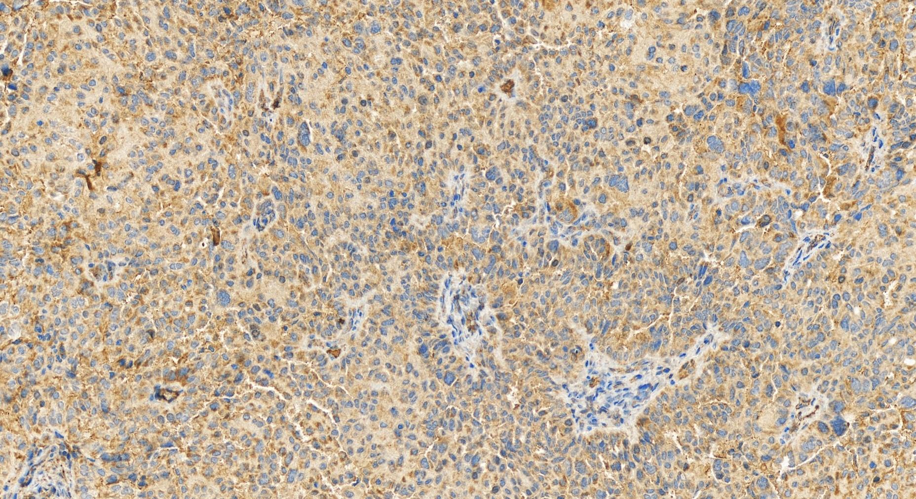 Immunohistochemistry (IHC) staining of human ovary cancer tissue using AFP Polyclonal antibody (14550-1-AP)