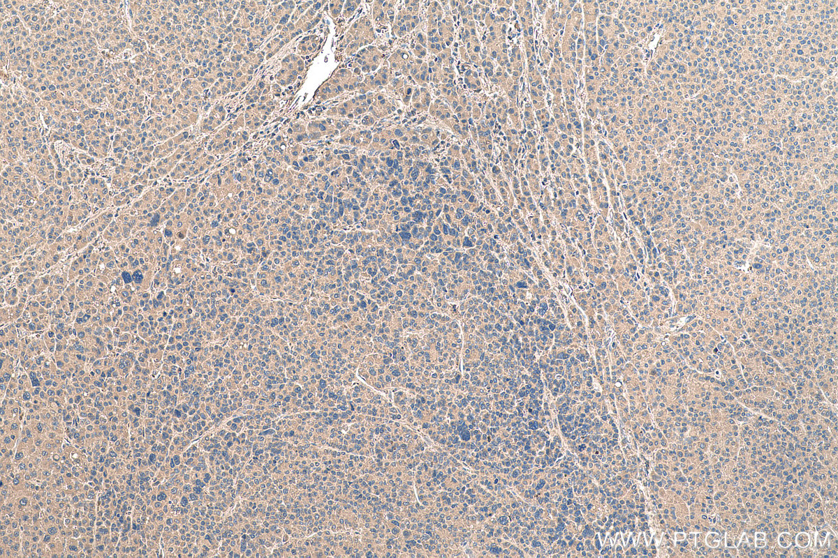 Immunohistochemistry (IHC) staining of human liver cancer tissue using AFP Monoclonal antibody (67852-1-Ig)