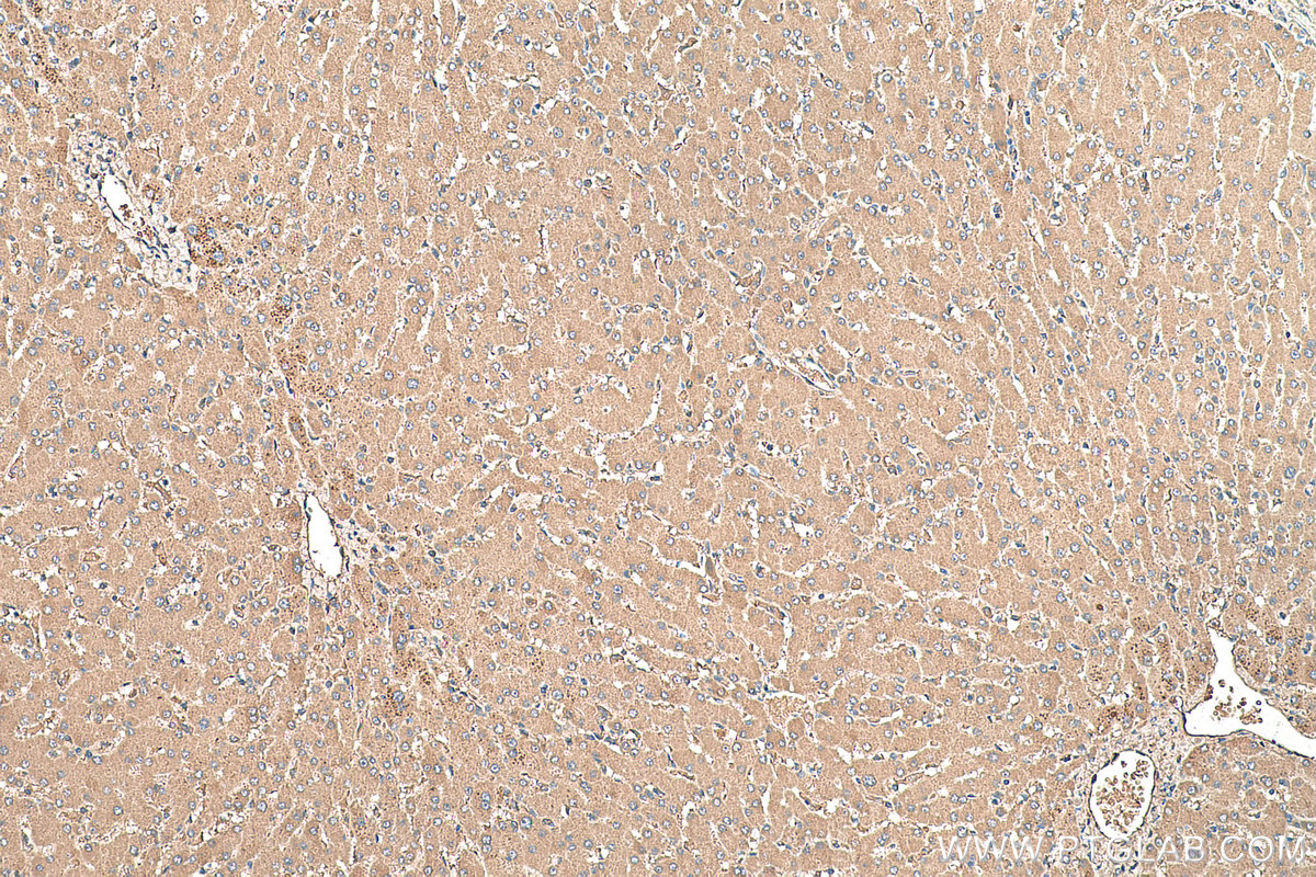 Immunohistochemistry (IHC) staining of human liver tissue using AFP Monoclonal antibody (67852-1-Ig)