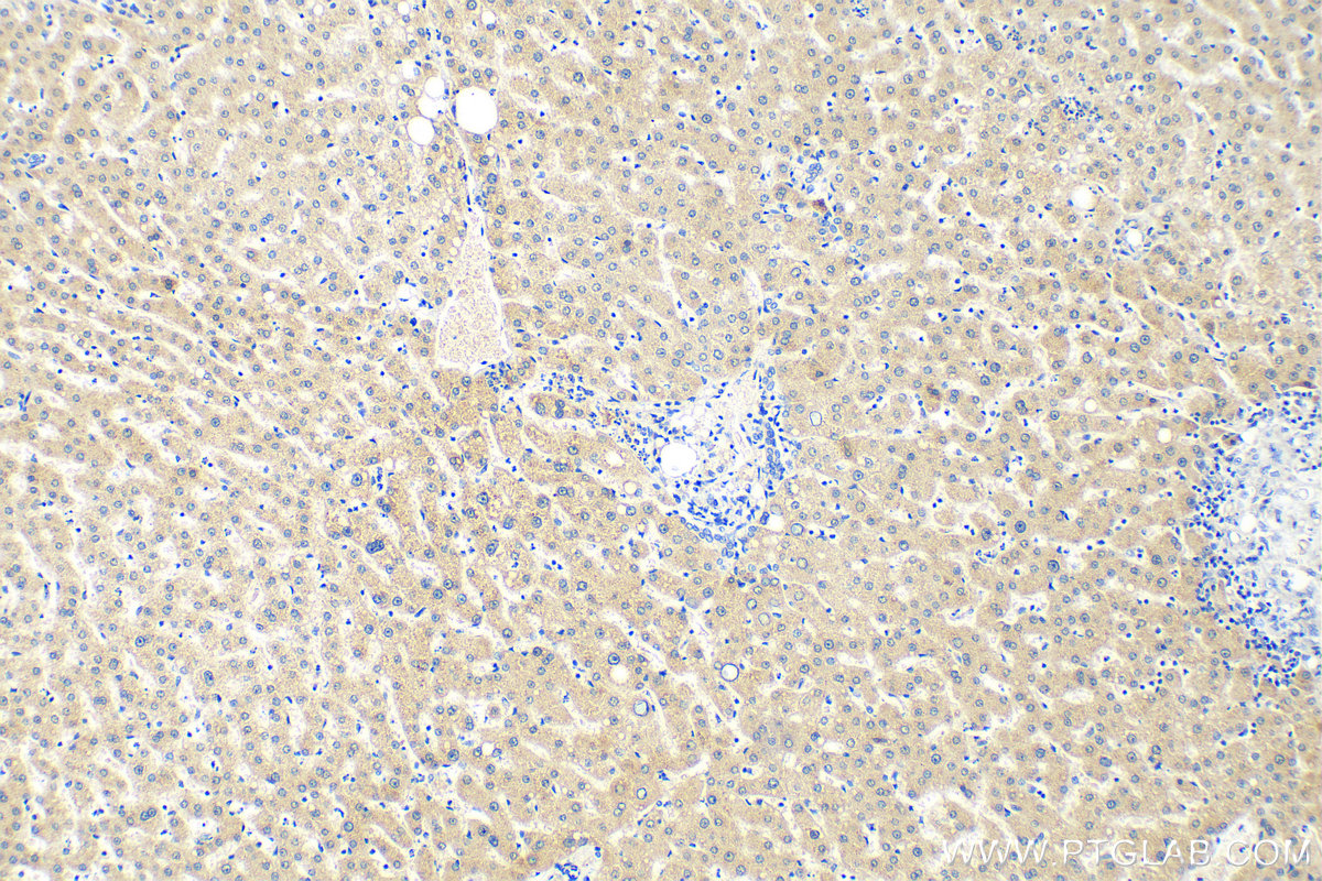 Immunohistochemistry (IHC) staining of human liver tissue using AFP Recombinant antibody (82982-6-RR)