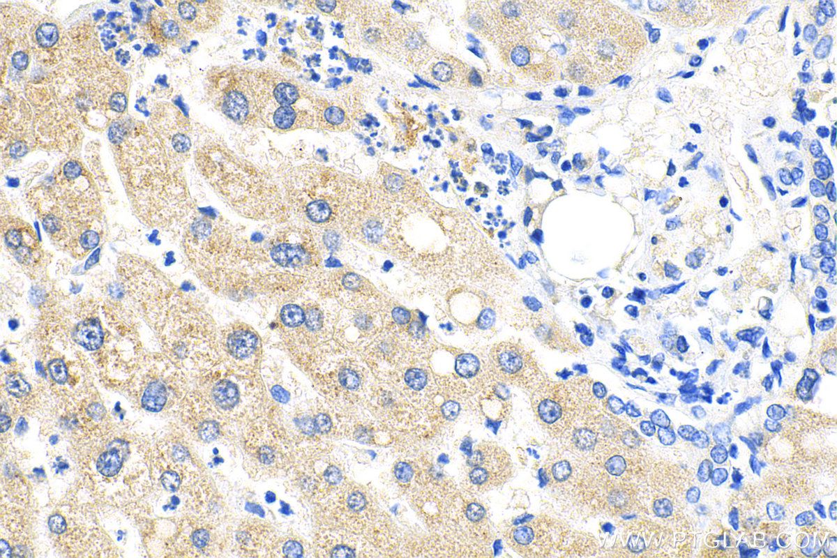 Immunohistochemistry (IHC) staining of human liver tissue using AFP Recombinant antibody (82982-6-RR)