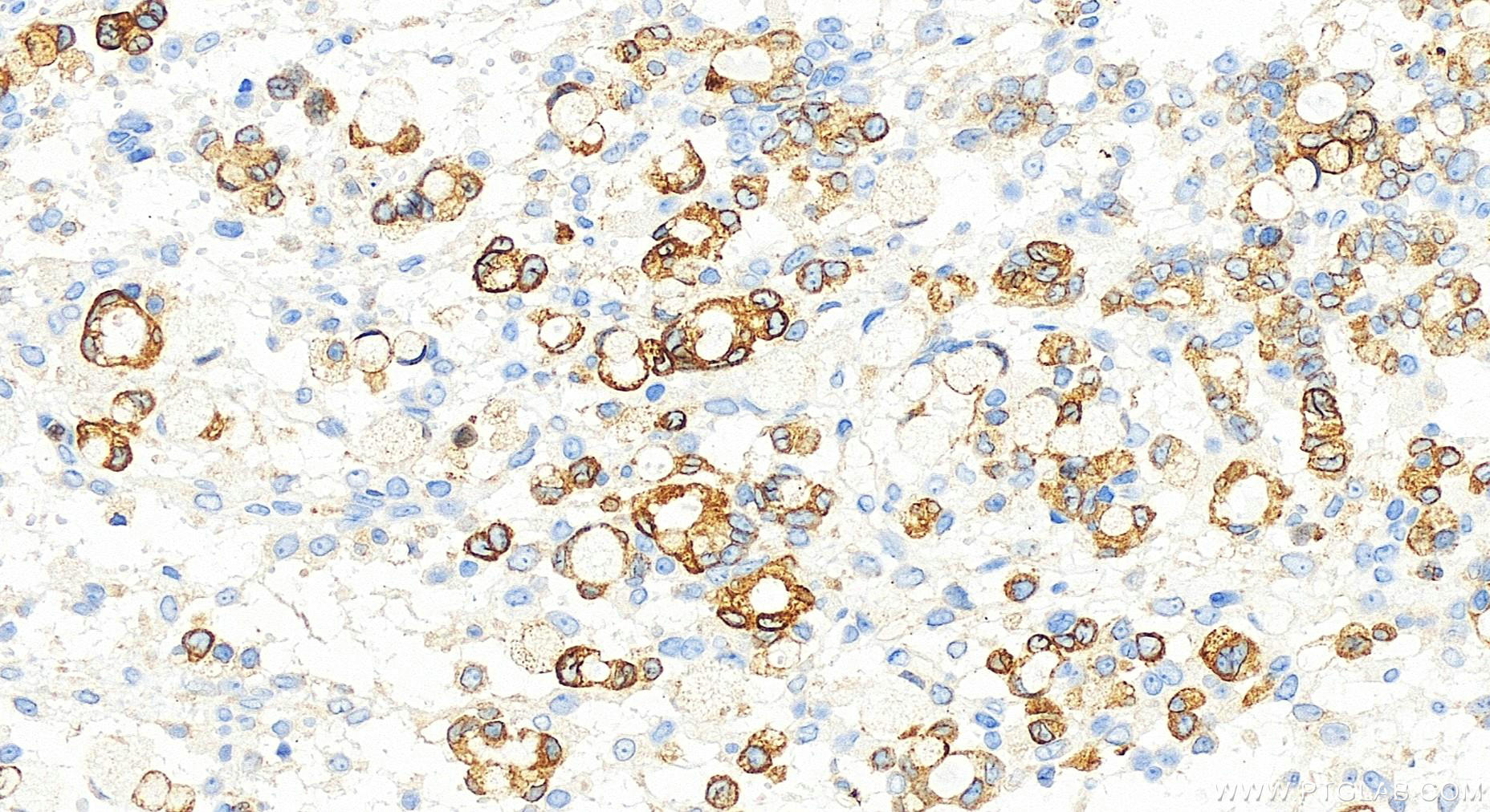 Immunohistochemistry (IHC) staining of human ovary cancer tissue using AGPAT2 Recombinant antibody (83349-3-RR)