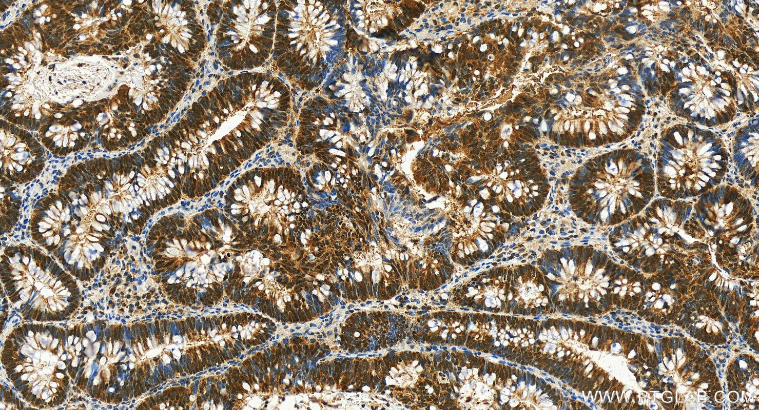 Immunohistochemistry (IHC) staining of human colon cancer tissue using AHCY Polyclonal antibody (10757-2-AP)