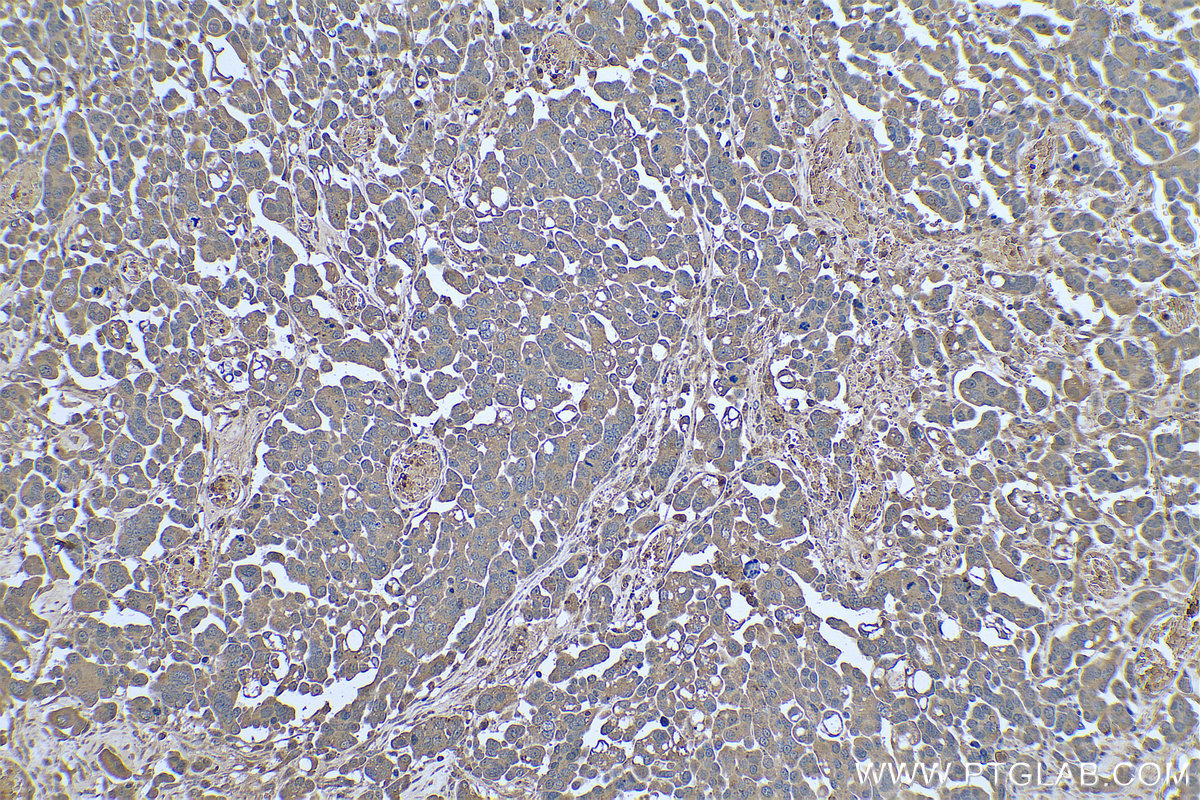 Immunohistochemistry (IHC) staining of human colon cancer tissue using AHCY Monoclonal antibody (66019-1-Ig)