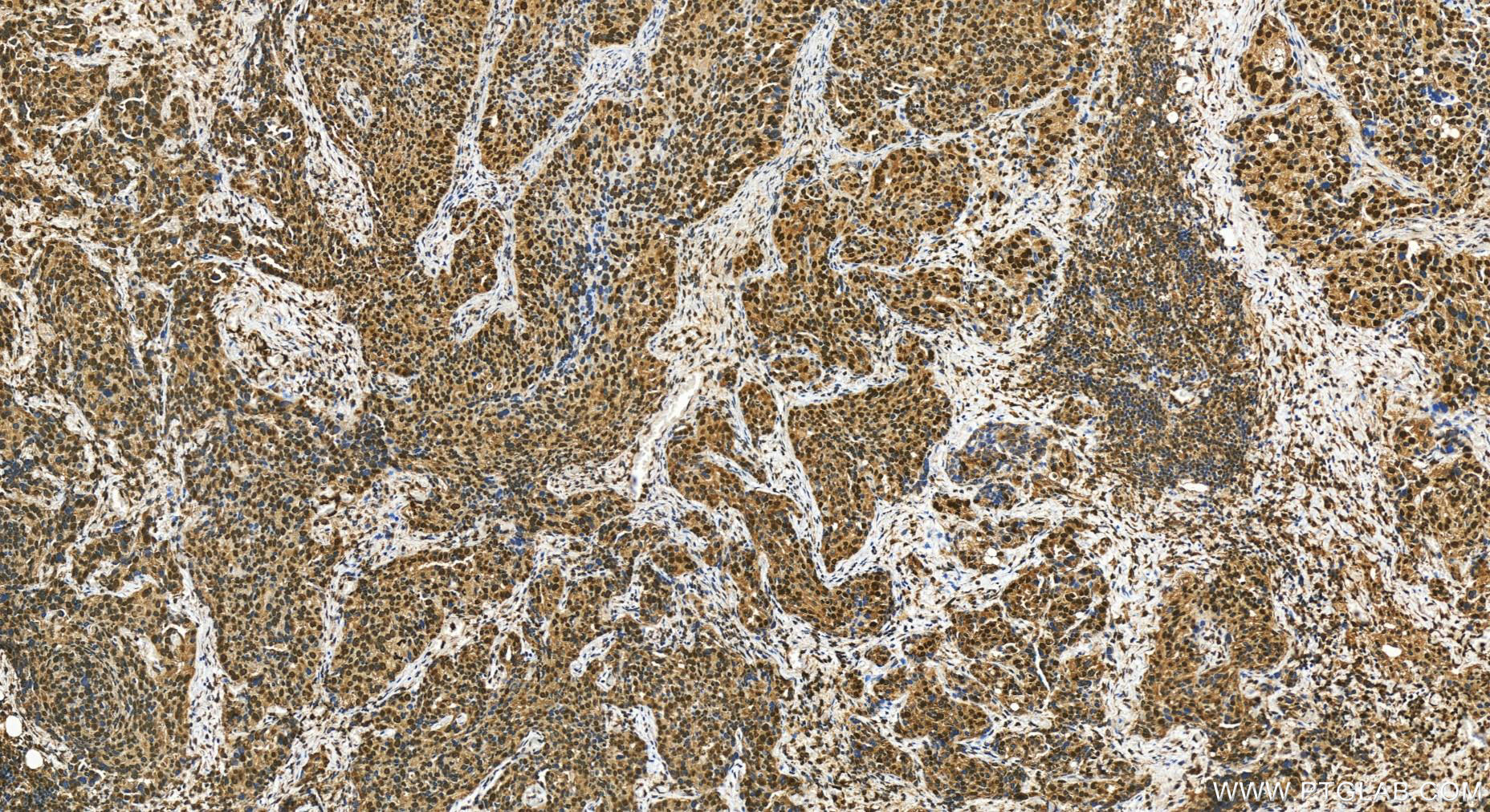 Immunohistochemistry (IHC) staining of human ovary cancer tissue using AHR Polyclonal antibody (30242-1-AP)