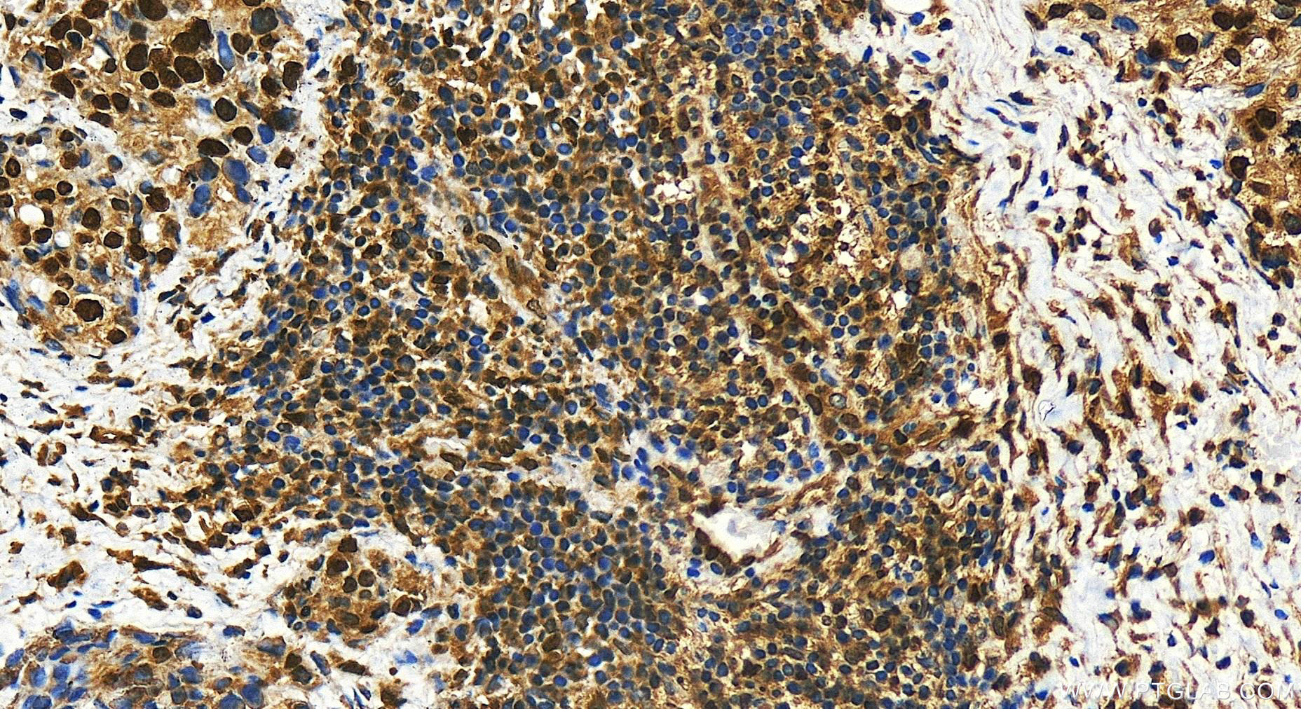 Immunohistochemistry (IHC) staining of human ovary cancer tissue using AHR Polyclonal antibody (30242-1-AP)