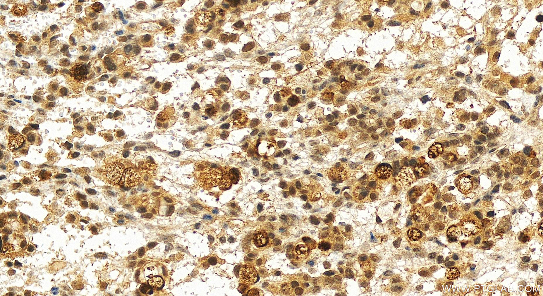 Immunohistochemistry (IHC) staining of human ovary cancer tissue using AHR Recombinant antibody (83369-5-RR)