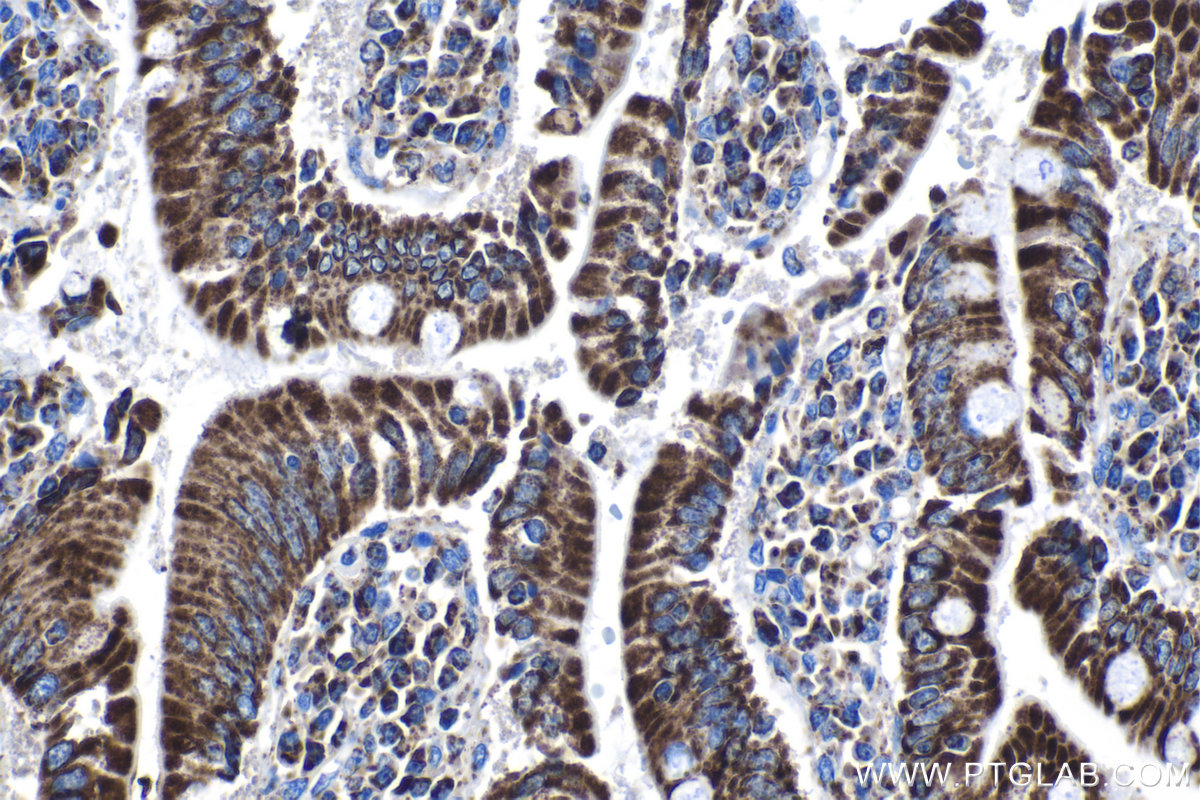 Immunohistochemistry (IHC) staining of human stomach cancer tissue using AIF Monoclonal antibody (67791-1-Ig)