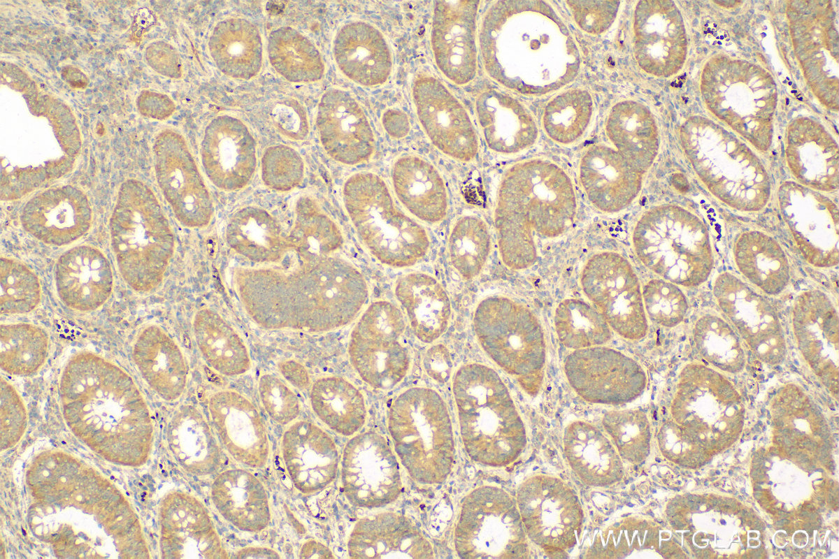 Immunohistochemistry (IHC) staining of human colon cancer tissue using AIFM3 Polyclonal antibody (14778-1-AP)