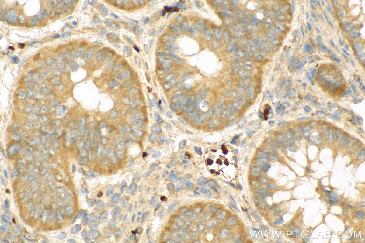 Immunohistochemistry (IHC) staining of human colon cancer tissue using AIFM3 Polyclonal antibody (14778-1-AP)