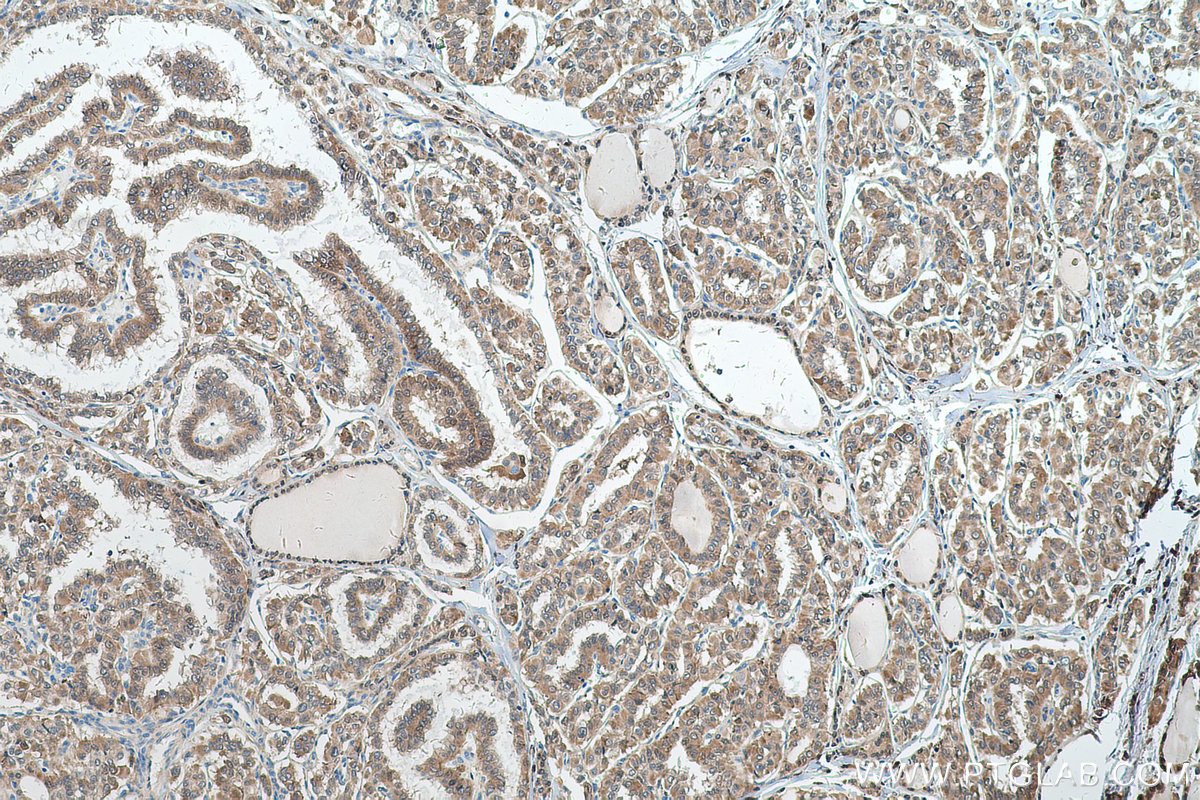 Immunohistochemistry (IHC) staining of human thyroid cancer tissue using AKR1A1 Polyclonal antibody (15054-1-AP)