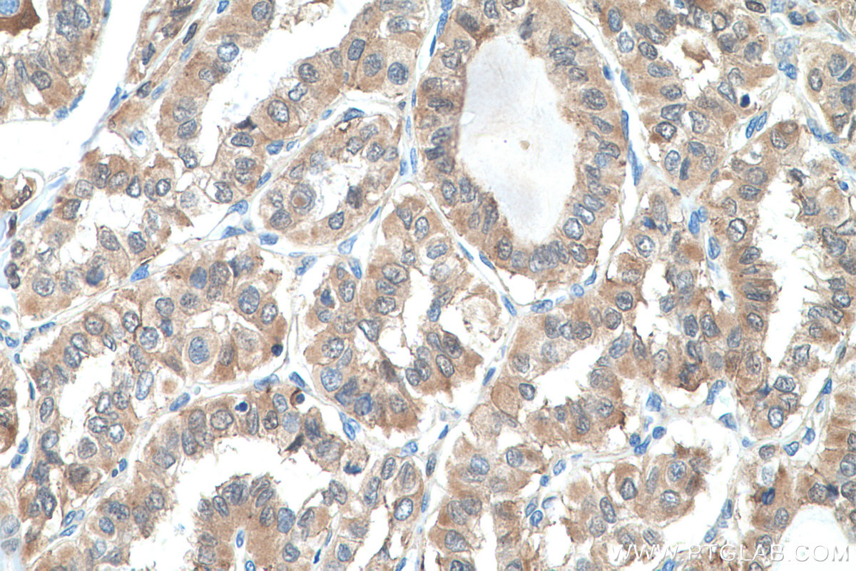 Immunohistochemistry (IHC) staining of human thyroid cancer tissue using AKR1A1 Polyclonal antibody (15054-1-AP)