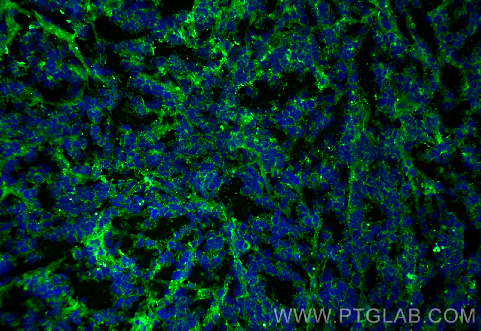 Immunofluorescence (IF) / fluorescent staining of mouse breast cancer using ALCAM Monoclonal antibody (67768-1-Ig)