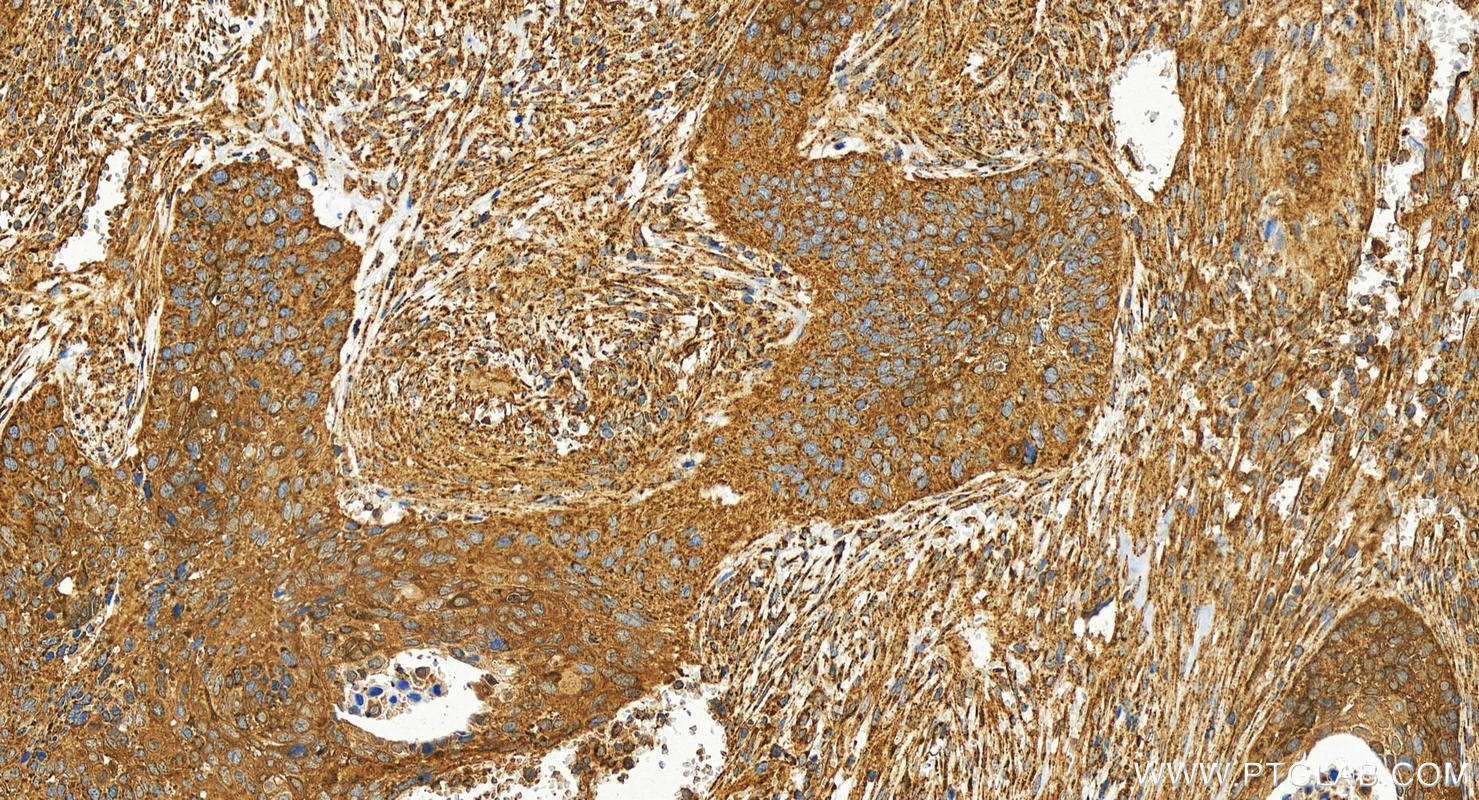 Immunohistochemistry (IHC) staining of human cervical squamous cancer tissue using ALDH1A1 Recombinant antibody (83830-2-RR)