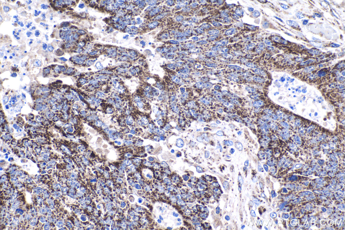 Immunohistochemistry (IHC) staining of human colon cancer tissue using ALDH1B1 Polyclonal antibody (22220-1-AP)