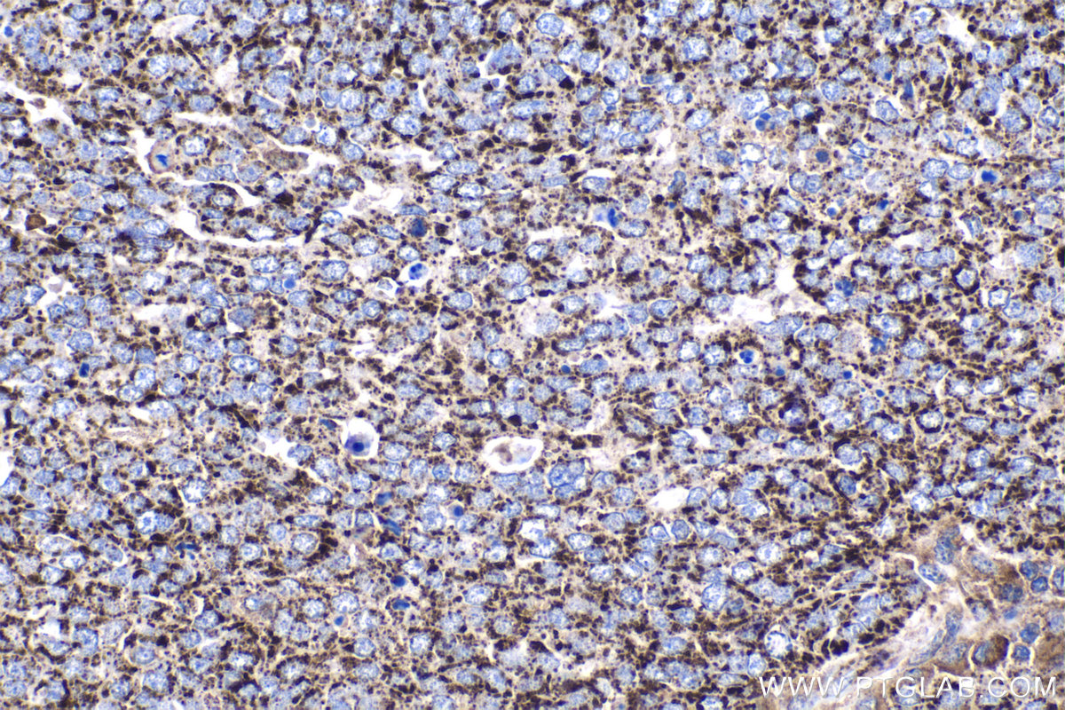 Immunohistochemistry (IHC) staining of human ovary tumor tissue using ALDH1B1 Polyclonal antibody (22220-1-AP)