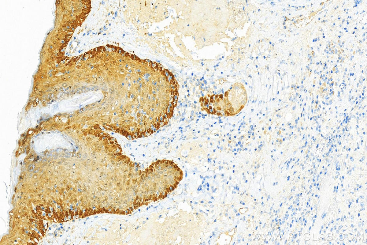 Immunohistochemistry (IHC) staining of human skin cancer tissue using ALDH3A1 Polyclonal antibody (15578-1-AP)