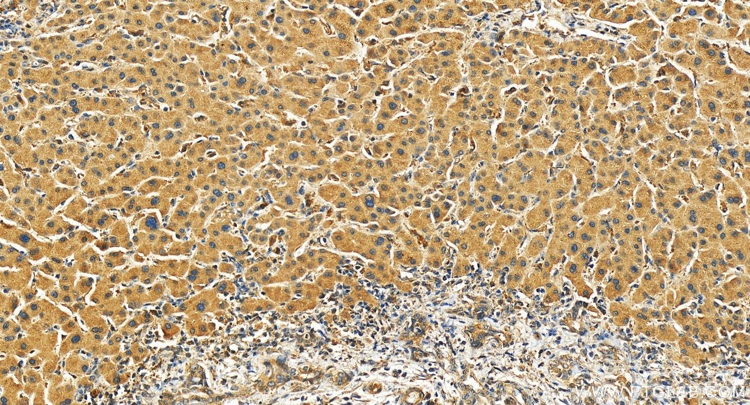 Immunohistochemistry (IHC) staining of human intrahepatic cholangiocarcinoma tissue using ALG11 Polyclonal antibody (27085-1-AP)