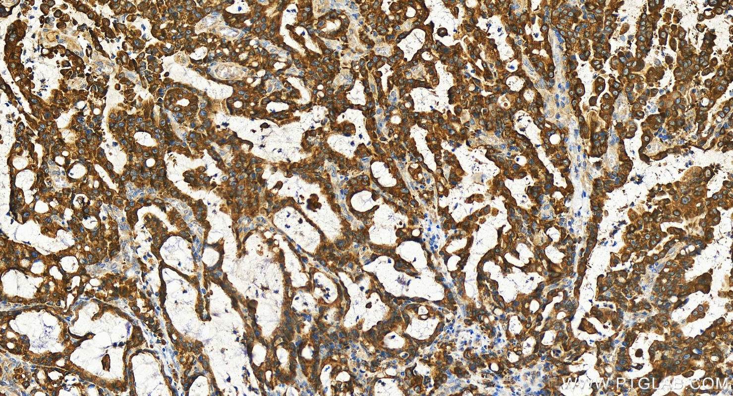 Immunohistochemistry (IHC) staining of human stomach cancer tissue using ALG9 Polyclonal antibody (29218-1-AP)