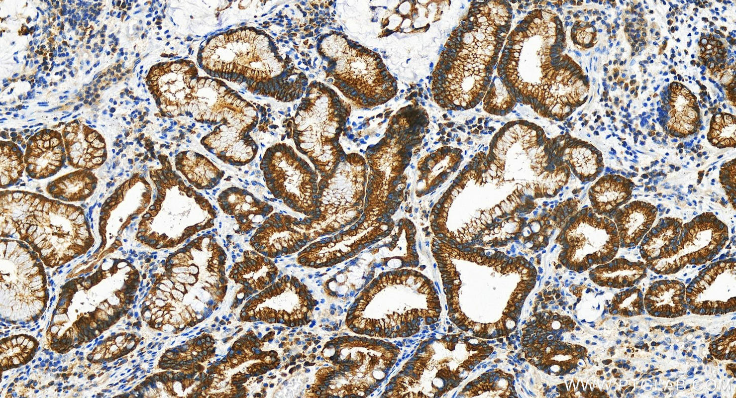 Immunohistochemistry (IHC) staining of human stomach cancer tissue using ALG9 Polyclonal antibody (29218-1-AP)