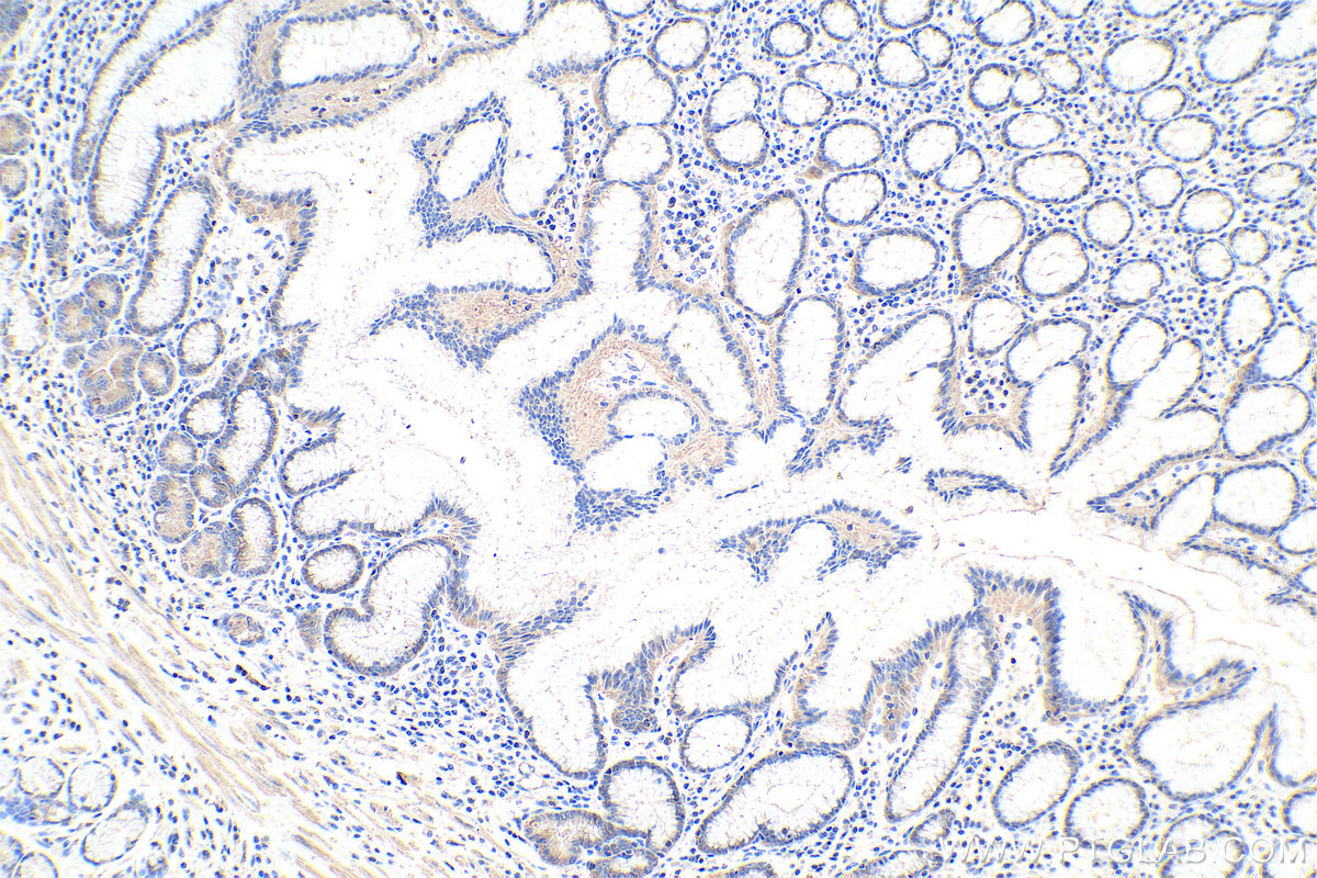 Immunohistochemistry (IHC) staining of human stomach cancer tissue using Alix Monoclonal antibody (67715-1-Ig)