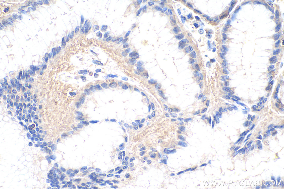 Immunohistochemistry (IHC) staining of human stomach cancer tissue using Alix Monoclonal antibody (67715-1-Ig)