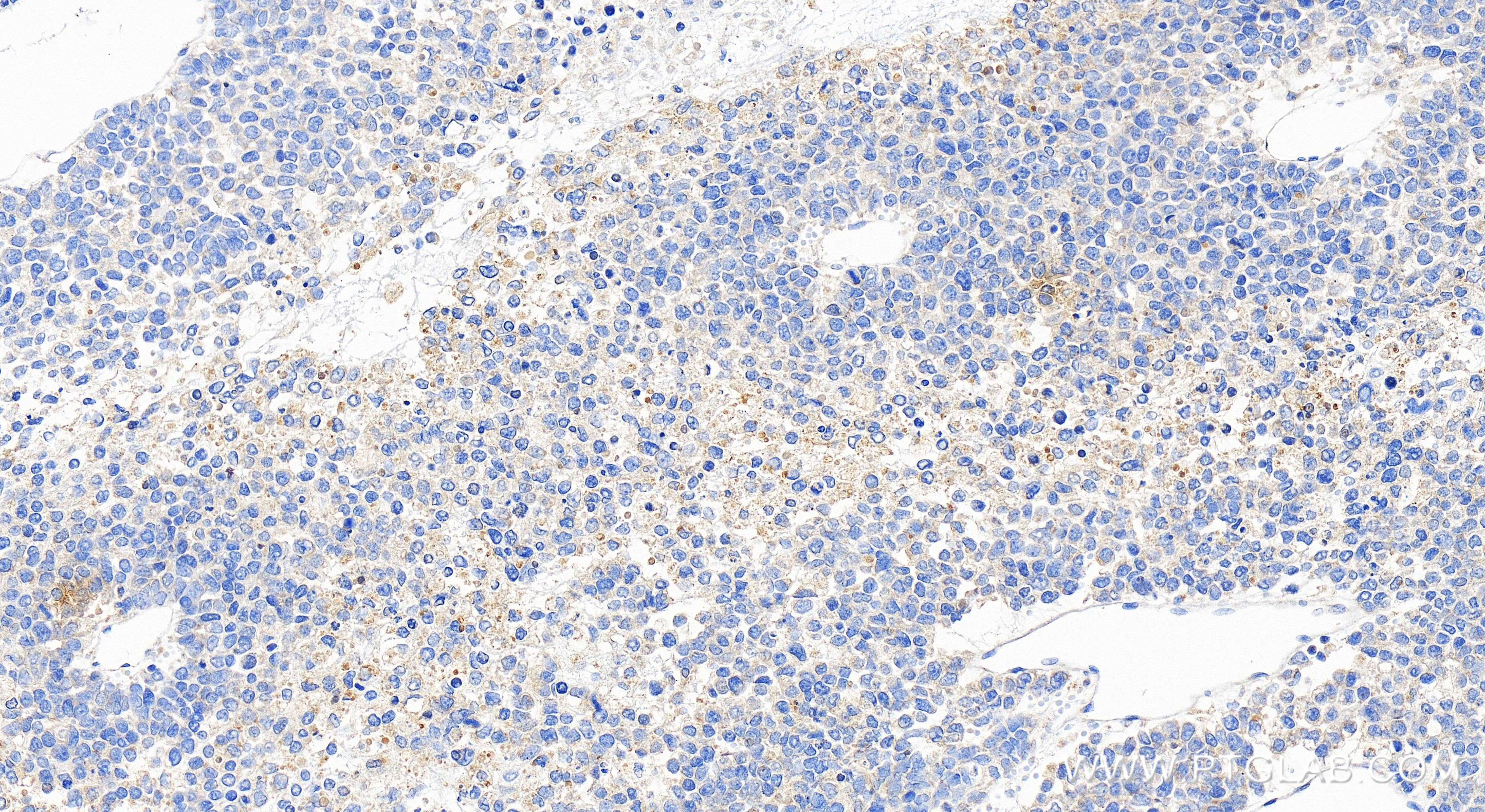 Immunohistochemistry (IHC) staining of human liver cancer tissue using ALR Recombinant antibody (84972-4-RR)