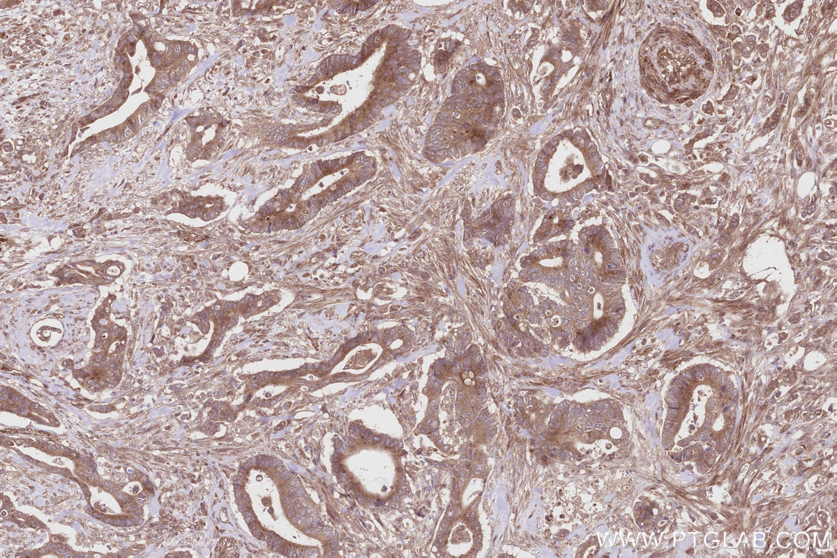 Immunohistochemistry (IHC) staining of human rectal cancer tissue using ALS2 Polyclonal antibody (13998-1-AP)