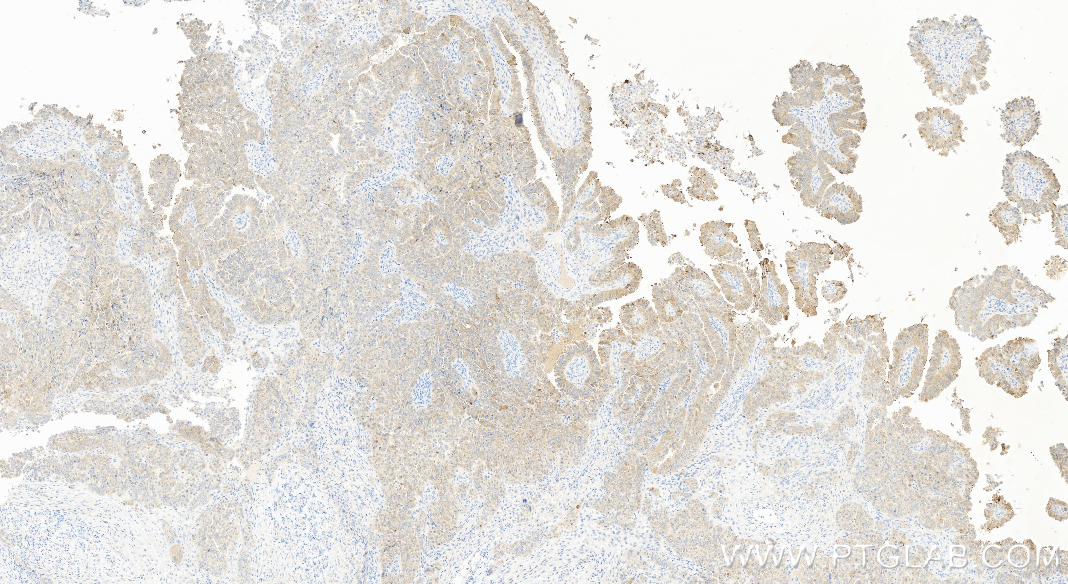 Immunohistochemistry (IHC) staining of human ovary cancer tissue using AMH Recombinant antibody (84153-5-RR)