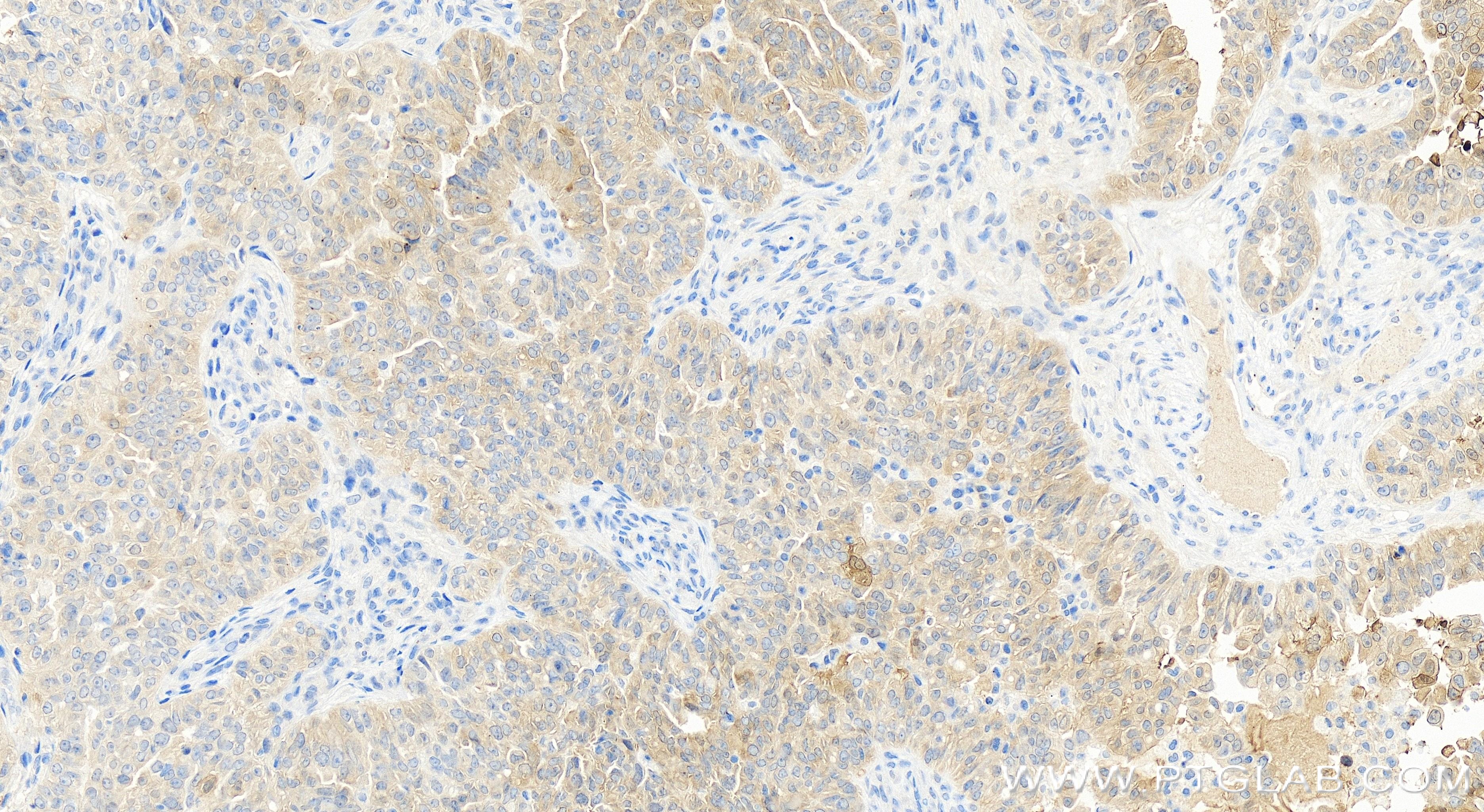 Immunohistochemistry (IHC) staining of human ovary cancer tissue using AMH Recombinant antibody (84153-5-RR)