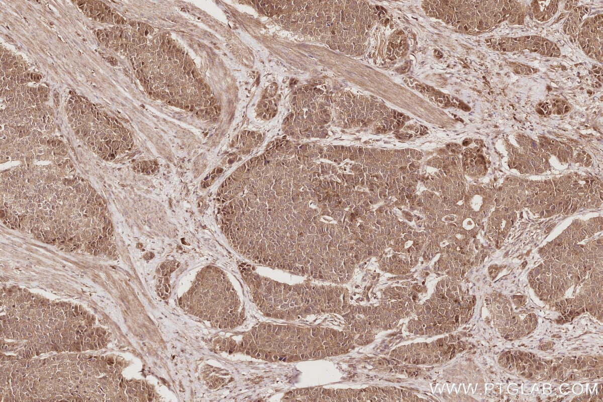 Immunohistochemistry (IHC) staining of human stomach cancer tissue using APC1 Polyclonal antibody (21748-1-AP)