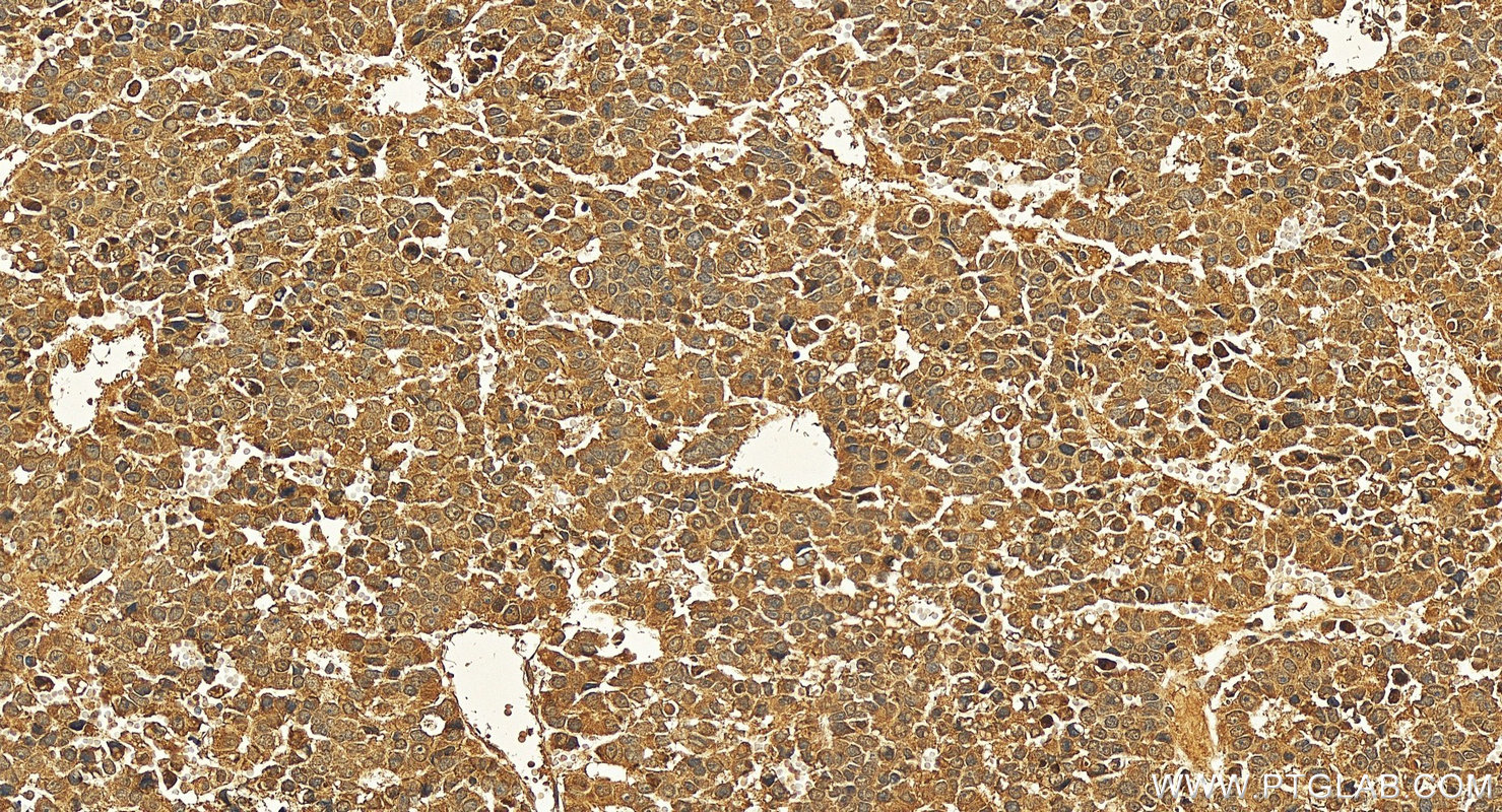 Immunohistochemistry (IHC) staining of human Hepatocellular carcinoma using Angiogenin Polyclonal antibody (18302-1-AP)