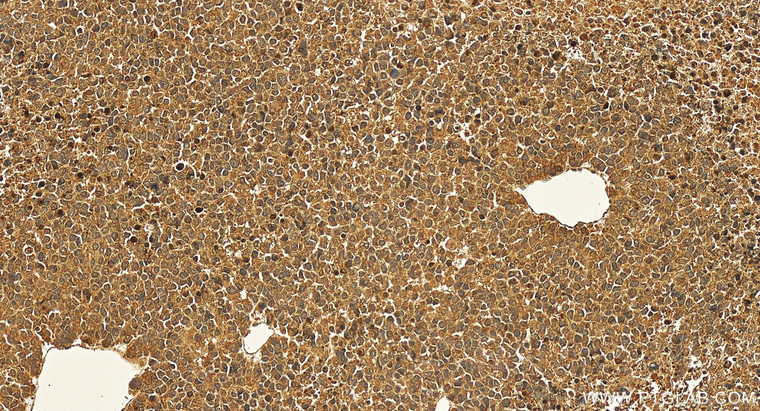 Immunohistochemistry (IHC) staining of human Hepatocellular carcinoma using Angiogenin Polyclonal antibody (18302-1-AP)