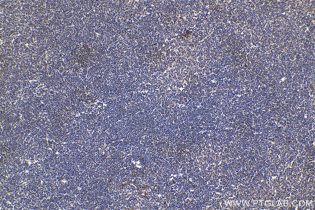 Immunohistochemistry (IHC) staining of human lymphoma tissue using ANK1 Polyclonal antibody (23938-1-AP)