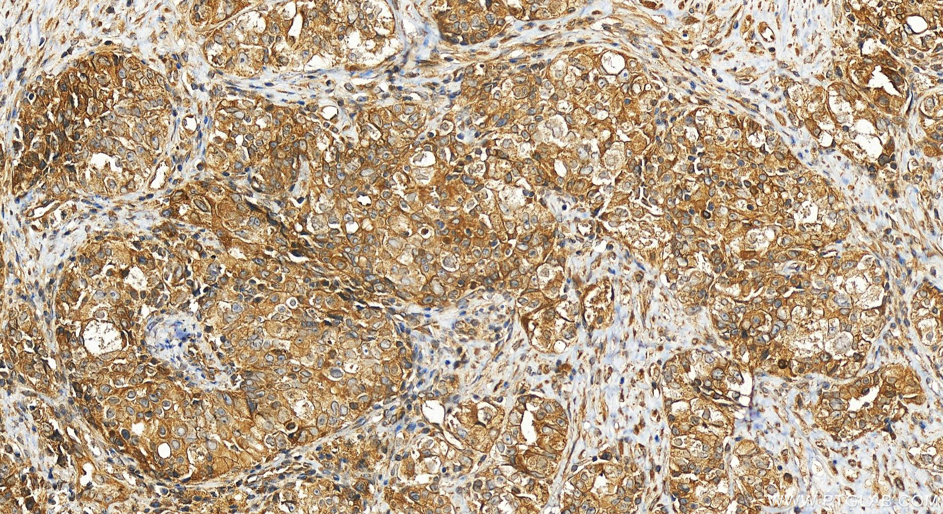 Immunohistochemistry (IHC) staining of human ovary cancer tissue using ANKLE2 Polyclonal antibody (26293-1-AP)