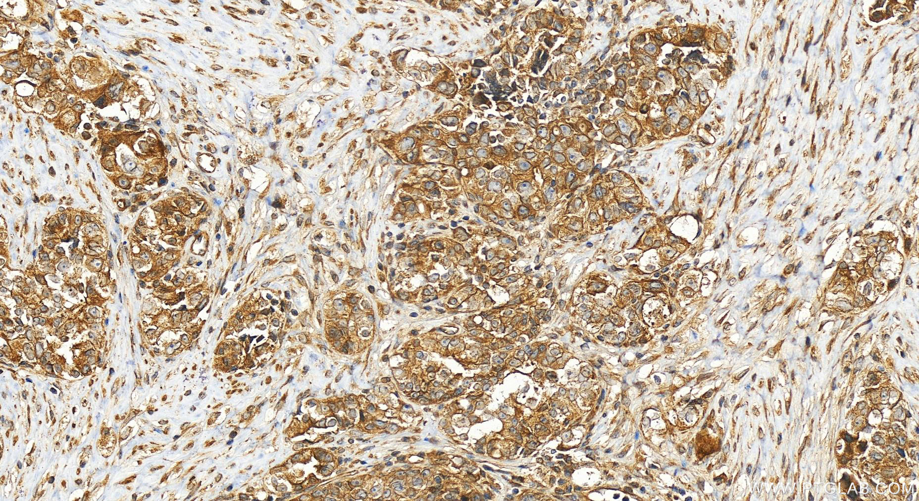 Immunohistochemistry (IHC) staining of human ovary cancer tissue using ANKLE2 Polyclonal antibody (26293-1-AP)