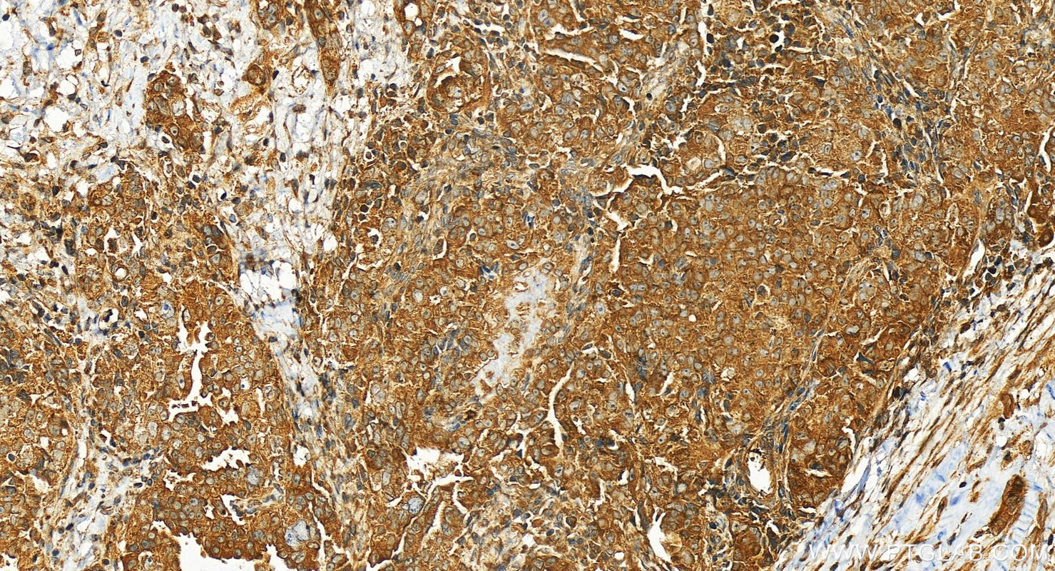 Immunohistochemistry (IHC) staining of human ovary cancer tissue using ANKRD16 Polyclonal antibody (24334-1-AP)