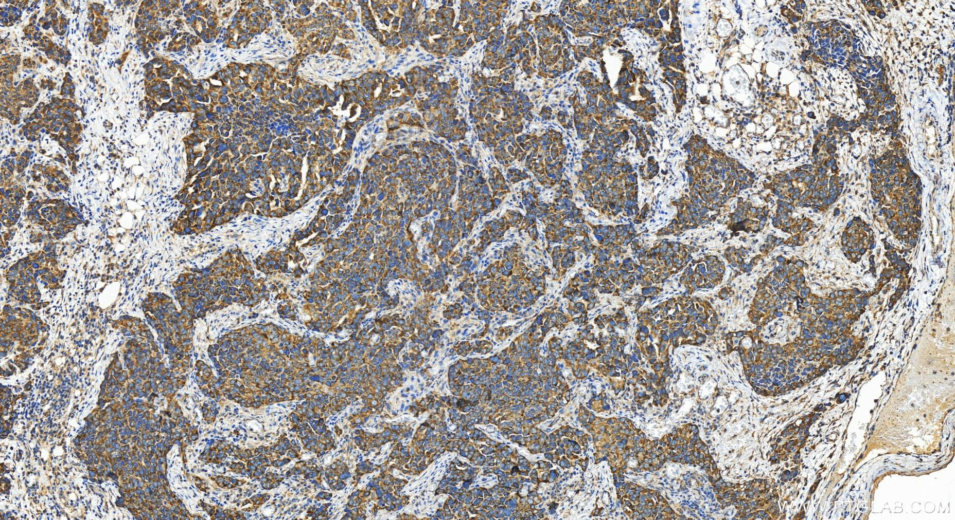 Immunohistochemistry (IHC) staining of human ovary cancer tissue using ANKRD17 Polyclonal antibody (27701-1-AP)