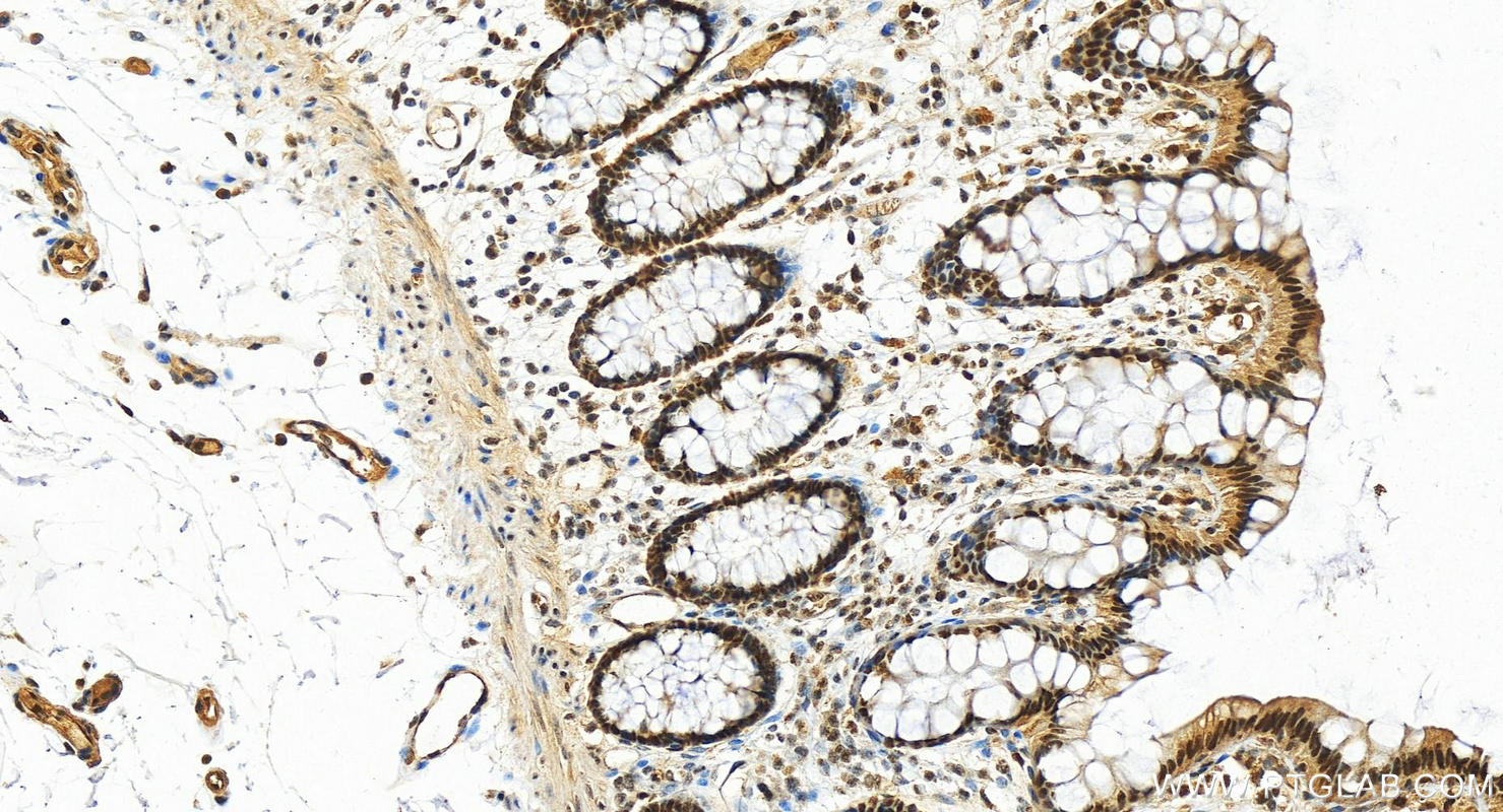 Immunohistochemistry (IHC) staining of human colon tissue using ANP32B Polyclonal antibody (10843-1-AP)