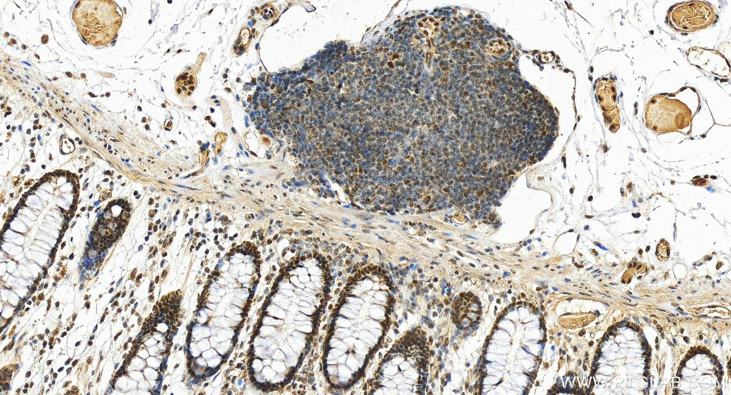 Immunohistochemistry (IHC) staining of human colon tissue using ANP32B Polyclonal antibody (10843-1-AP)