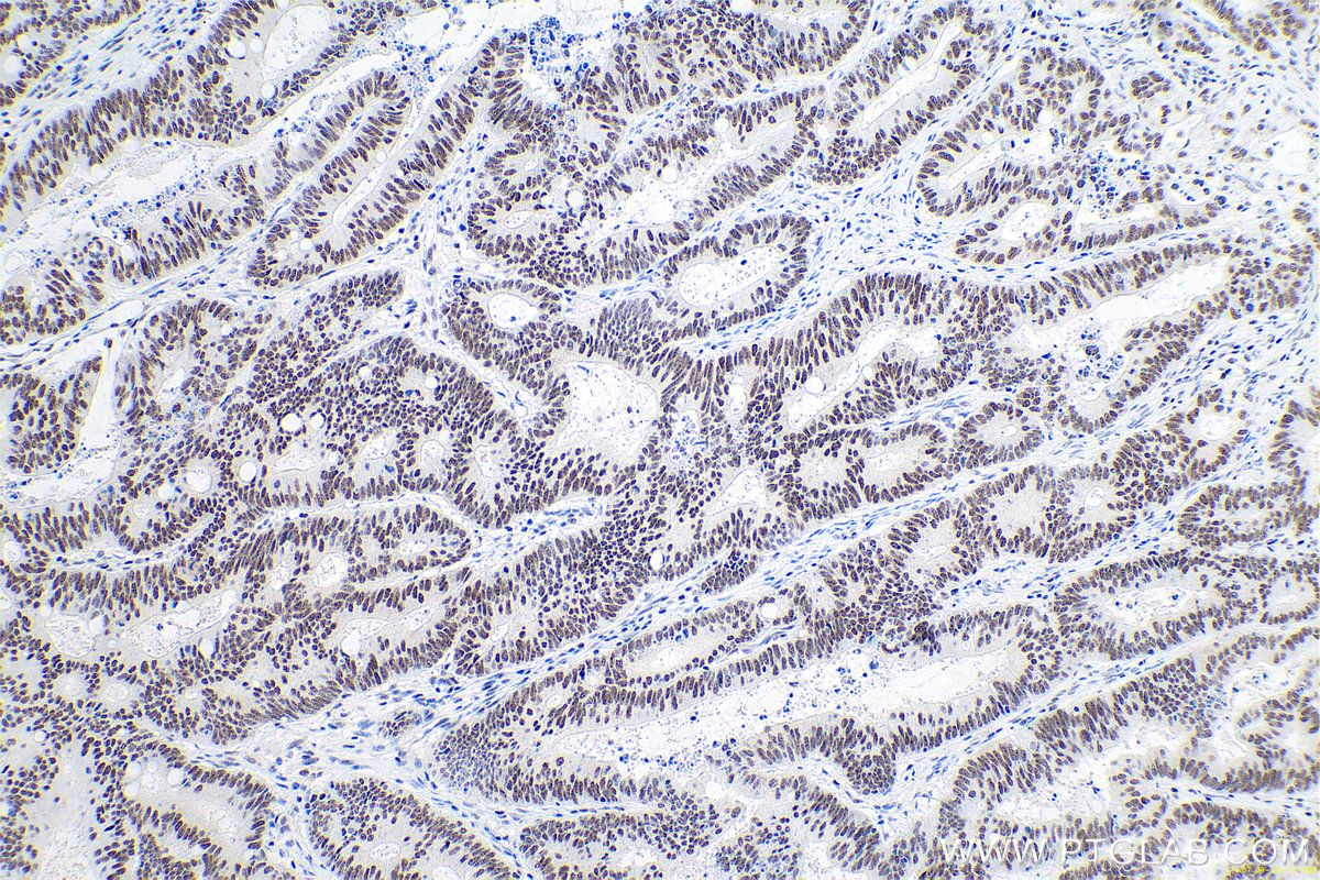 Immunohistochemistry (IHC) staining of human colon cancer tissue using ANP32B Monoclonal antibody (66160-1-Ig)