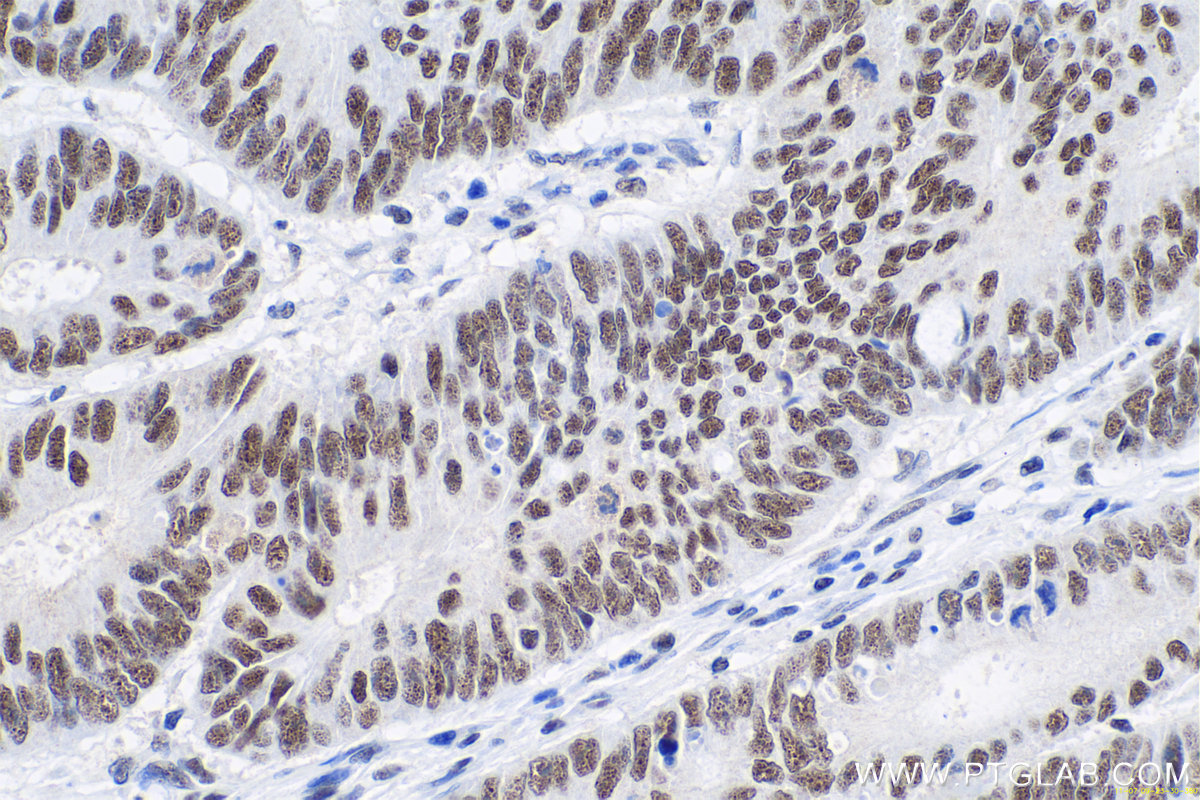 Immunohistochemistry (IHC) staining of human colon cancer tissue using ANP32B Monoclonal antibody (66160-1-Ig)