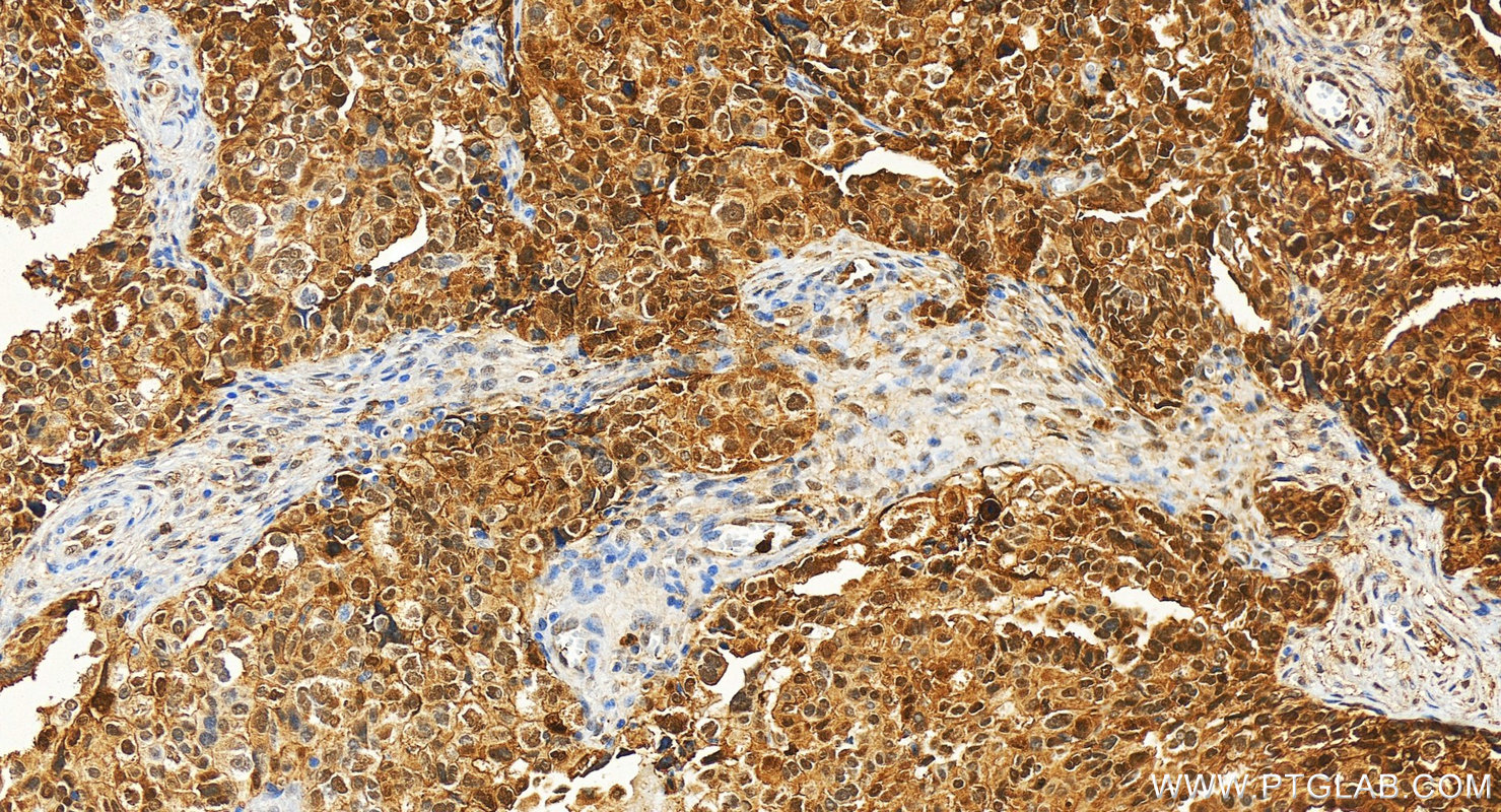 Immunohistochemistry (IHC) staining of human ovary cancer tissue using Annexin A1 Polyclonal antibody (21990-1-AP)