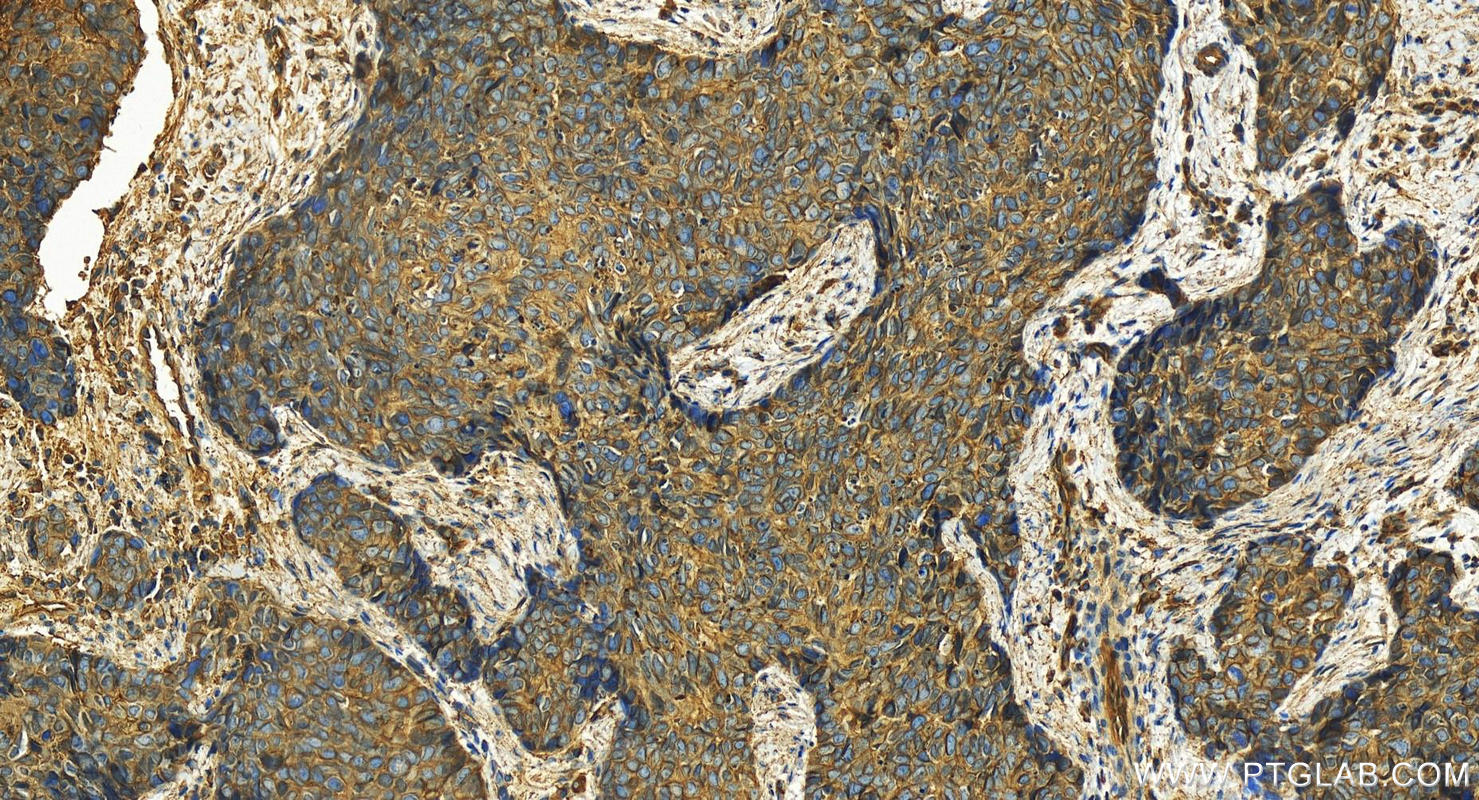 Immunohistochemistry (IHC) staining of human bowen disease using Annexin A2 Polyclonal antibody (11256-1-AP)