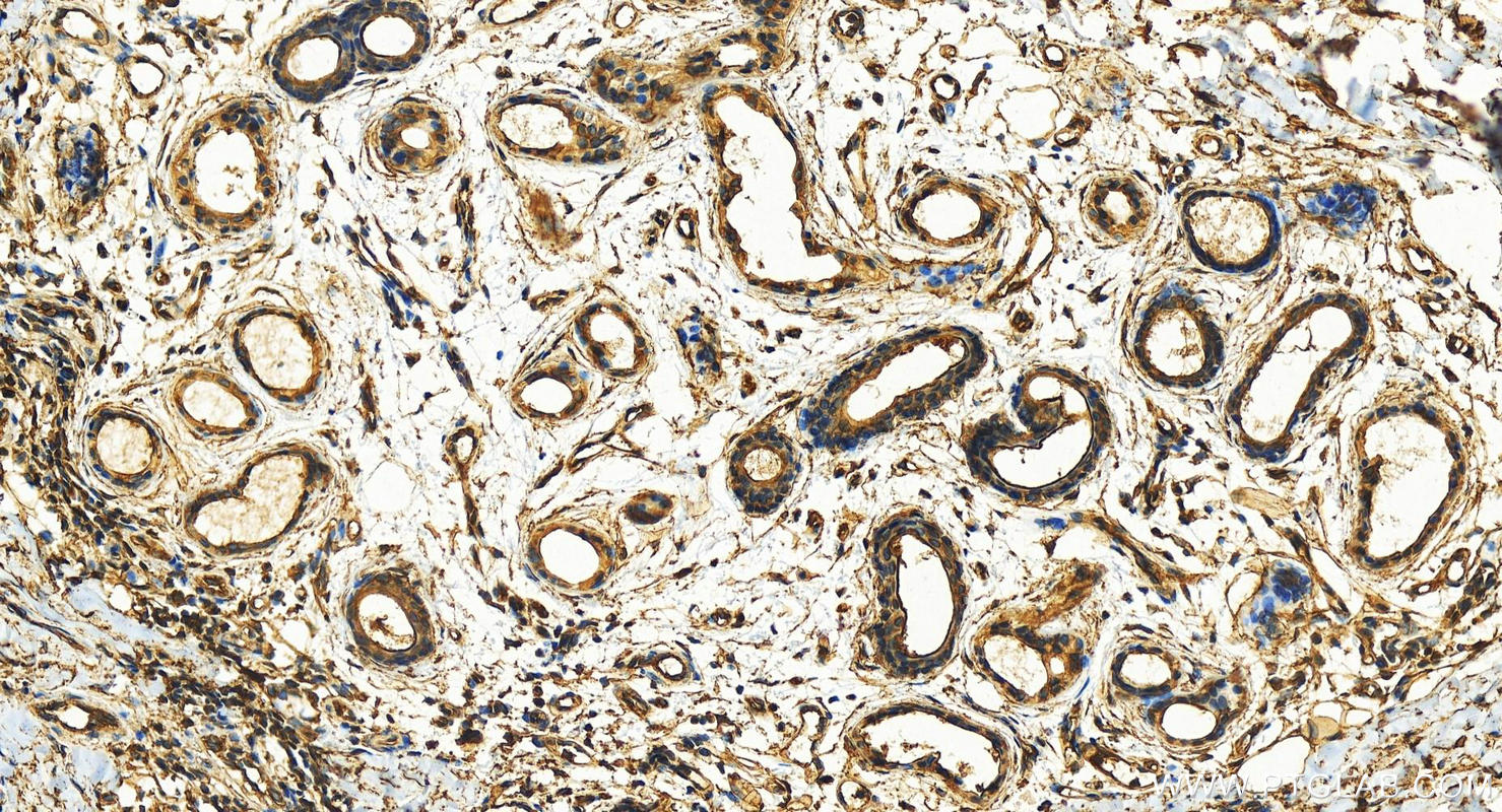 Immunohistochemistry (IHC) staining of human bowen disease using Annexin A2 Polyclonal antibody (11256-1-AP)