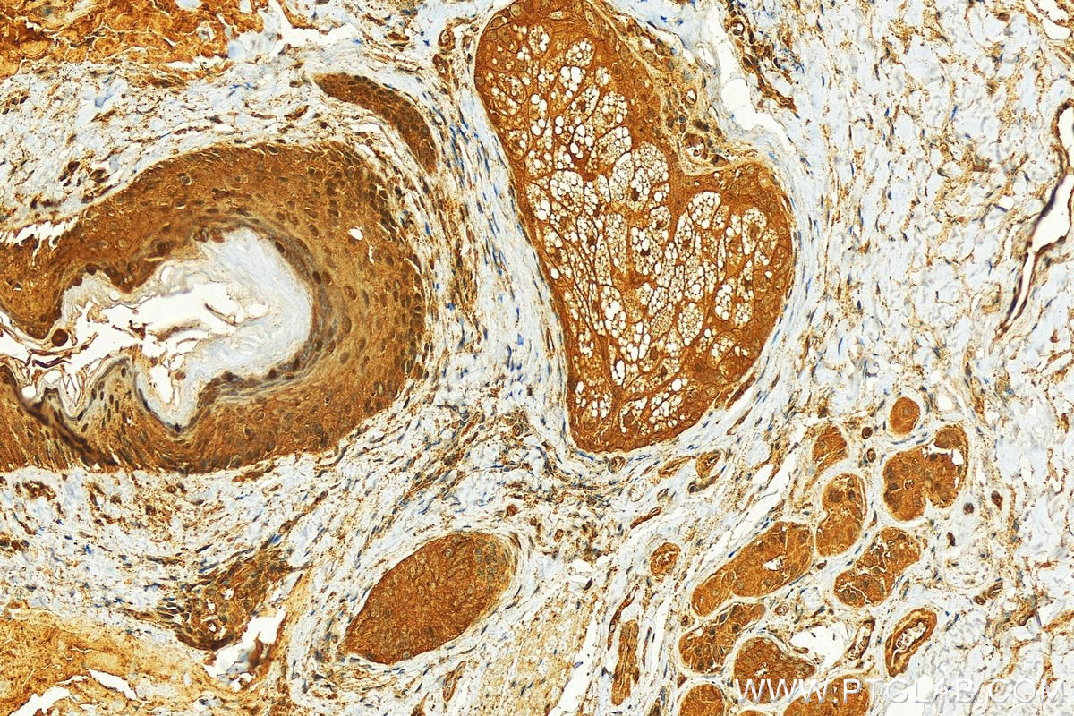 Immunohistochemistry (IHC) staining of human skin cancer tissue using JUN Polyclonal antibody (22114-1-AP)