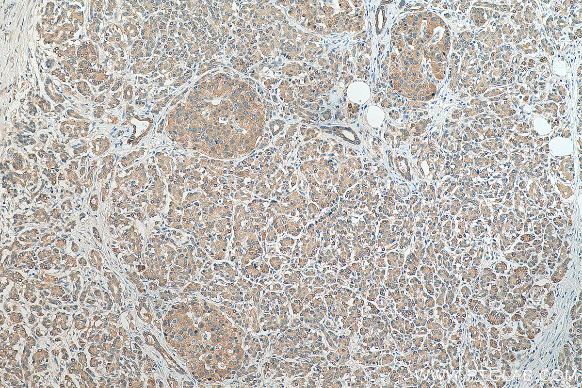 Immunohistochemistry (IHC) staining of human pancreas cancer tissue using AP1M2 Polyclonal antibody (10618-1-AP)