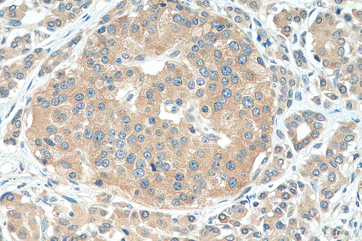 Immunohistochemistry (IHC) staining of human pancreas cancer tissue using AP1M2 Polyclonal antibody (10618-1-AP)